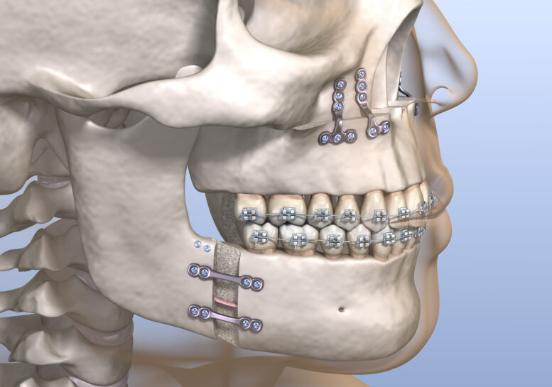 Cirurgia ortognática: o que é e quando ela se torna a melhor opção de tratamento Cirurgia ortognática: o que é e quando ela se torna a melhor opção de tratamento