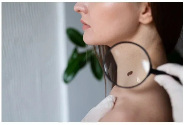 Junho Preto: Campanha ressalta prevenção e alerta para crescimento do melanoma no Brasil Junho Preto: Campanha ressalta prevenção e alerta para crescimento do melanoma no Brasil