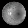 Corante natural brasileiro pode tornar cirurgias de retina mais precisas e seguras